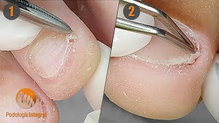 2 cases 1 video X  Removal of onychophosis that is very bothersome when putting on shoes [upl. by Notfilc114]