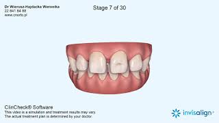 Szpary między zębami diastema zgryz głęboki  leczenie ortodontyczne [upl. by Elleirda63]