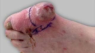 Draining pus from a foot infection [upl. by Noned]