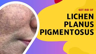 Get Rid of Lichen Planus Pigmentosus [upl. by Arlyne]