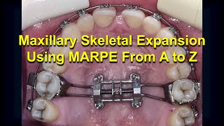 Maxillary Skeletal Expansion using MARPE from A to Z Updated [upl. by Alcina]