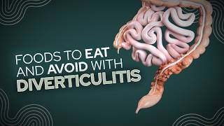 Foods To Eat and Avoid With Diverticulitis [upl. by Noellyn]