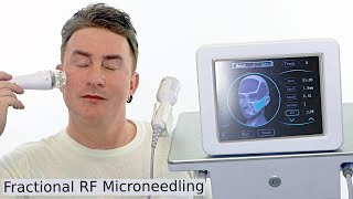 Fractional Radiofrequency Microneedling Skin Tightening  Before amp After [upl. by Rana]