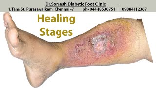 Cellulitis Infection healing stages [upl. by Sarah]