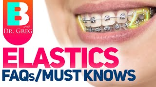 Braces Elastics  Rubber Bands – 5 Most Common Questions [upl. by Clarkson]