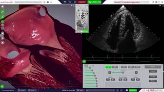 HeartWorks Hypertrophic Cardiomyopathy [upl. by Ardni]