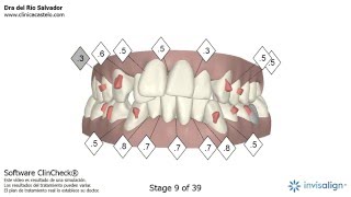 Clincheck Invisalign  Vídeo en 3D [upl. by Stanway]