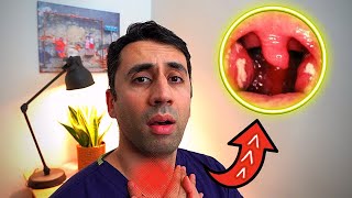 What Causes a Sore Throat HOME Remedies and Cures for Fast TREATMENT Doctor Explains [upl. by Richards]