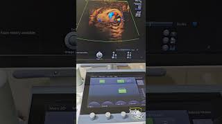 Testicular Torsion  Early Subacute Stage  Ultrasound [upl. by Livi]