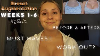 Breast augmentation  weeks 16 post op [upl. by Pansy]