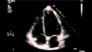 Echocardiogram [upl. by Jakie]