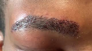 AfricanAmerican Male Eyebrow Hair Transplant Closeup 1 Day Out [upl. by Okihcim]