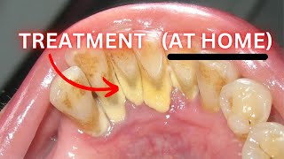 Gingivitis HOME Treatment Did Your Dentist Lie To You [upl. by Socha]