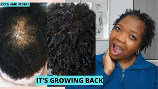 CCCA HAIR LOSS JOURNEY UPDATE  CCCA ALOPECIA [upl. by Henn]