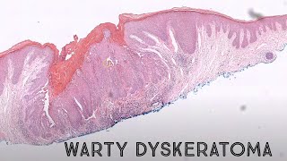 Warty Dyskeratoma acantholytic dyskeratosis pathology dermpath dermatology dermatopathology [upl. by Syla]