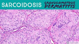 Sarcoidosis amp Granulomatous Dermatitis Pattern  Inflammatory Dermatopathology Basics [upl. by Burdelle730]