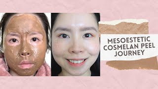 Cosmelan Treatment by Mesoestetic  Removal of Freckles Melasma amp Pigmentation [upl. by Haeel385]