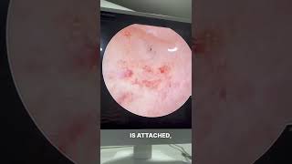 Removing Uterine Polyps What to Expectdrsuniljindalbestivf uterus baby polyp removal cavity [upl. by Nikolai]