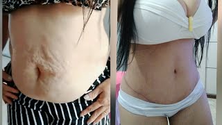 Minha Abdominoplastia ➡️ Dia da cirurgia  o que levei para o hospital 3 [upl. by Nwahsyar]