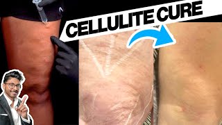 How To Get Rid Of Celulite  Removal Sunekos Cell [upl. by Kornher450]