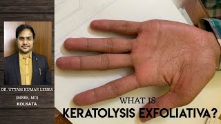 Keratolysis ExfoliativaRepeated peeling of skin from palm and sole Hath aur paw se Chamdi Nikalna [upl. by Beatty938]