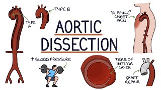 Understanding Aortic Dissection [upl. by Ketty959]