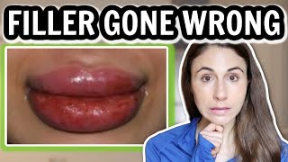 FILLER GONE WRONG 😮 TOP 5 FILLER COMPLICATIONS 💉DERMATOLOGIST DrDrayzday [upl. by Ochs]