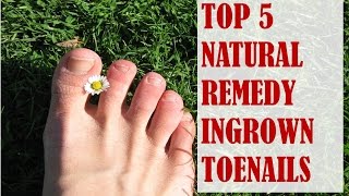 Top 5 Natural Remedies for Ingrown Toenails [upl. by Flan276]