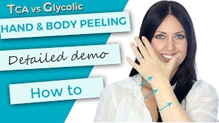 Hand and Body Peeling  Tutorial  Demonstration  TCA 30 versus Glycolic 70 [upl. by Ahsenak]