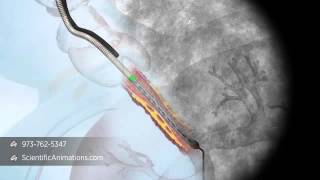 3D Medical Animation of Tracheal Stent Procedure [upl. by Rodina]