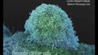 Electron microscopy of cancer cells from Cancer Research UKfunded scientists [upl. by Isawk]