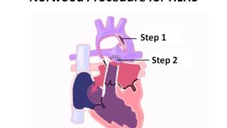 Norwood Procedure for Hypoplastic Left Heart Syndrome [upl. by Aldis]