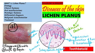 Oral Lichen planus Part 1 Causes Pathogenesis Clinical features Skin lesions [upl. by Nolyk729]