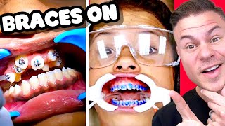 How Braces Are Put On  Watch Before You Get Braces [upl. by Sad]