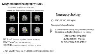 Periventricular Nodular Heterotopia with Samden Lhatoo MD and Nitin Tandon MD [upl. by Diamond]