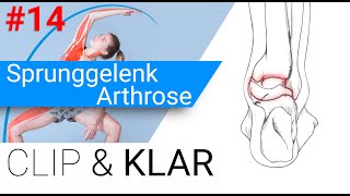 Sprunggelenk Arthrose erklärt  Abnutzung im oberen und unteren Sprunggelenk [upl. by Eaton]