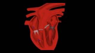 Auscultation insuffisance mitrale [upl. by Eldredge]