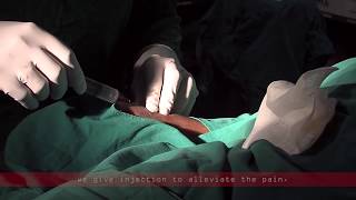 Coronary angiogram  a live demonstration [upl. by Anirpas]