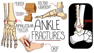 Ankle Fractures Made Easy [upl. by Ahrens350]