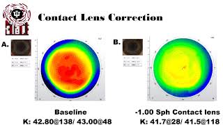 Anisometropia and Aniseikonia Treatment [upl. by Evatsug]