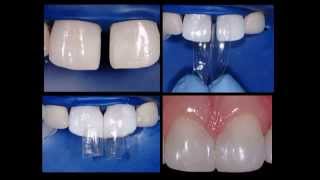 Bioclear  Diastema Closure [upl. by Timon]