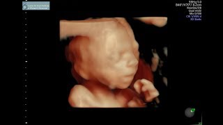 20 week ultrasound [upl. by Nwahsirhc]