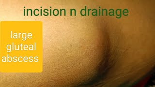 large gluteal abscess  incision n drainage dr youtube doctor [upl. by Margherita]