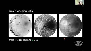 Leucemias y Linfomas [upl. by Selway]