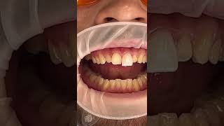 Veneers Process [upl. by Kristianson]