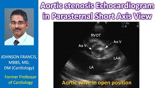 Aortic stenosis Echocardiogram in parasternal short axis view [upl. by Hollie]