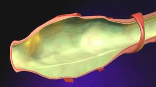 Bronchiectasis Animation  What is Bronchiectasis Videomp4 [upl. by Curry]