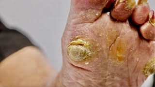 Callus removal from feetampFoot scraping dead skin【Xiao Yan pedicure】stress 1112 [upl. by Davie]