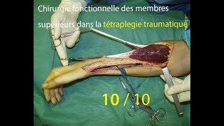 Membres supérieurs tétraplégiques 1010  indications [upl. by Oinotnas798]