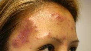 The Acne Practice severe case 5 [upl. by Eelyma]